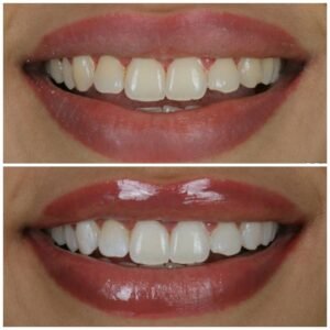 Smile Makeover