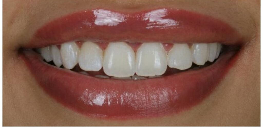 Case 7 smile transformation at Plexus Dental Studio