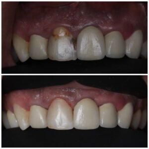 Smile Makeover