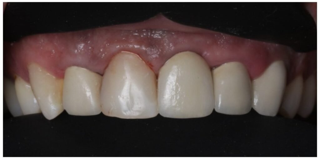 Case 8 smile transformation at Plexus Dental Studio