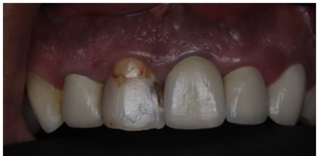 Case 8: Dental Bonding at Plexus Dental Studio