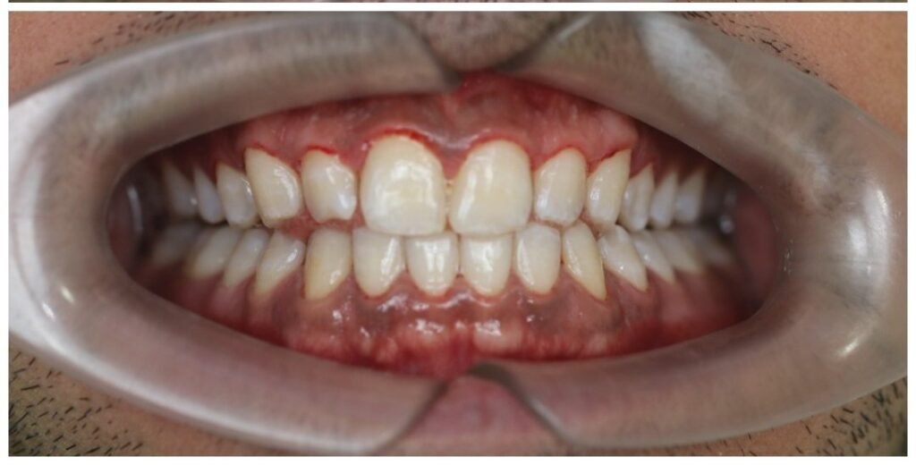 Case 9 smile transformation at Plexus Dental Studio