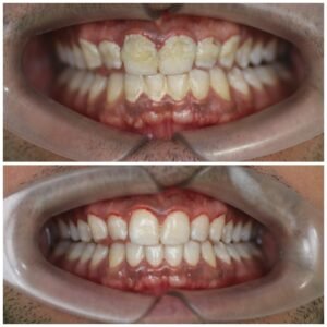 Smile Makeover