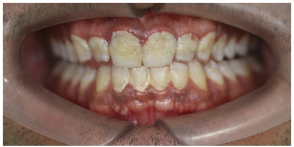 Case 9: Teeth Whitening at Plexus Dental Studio