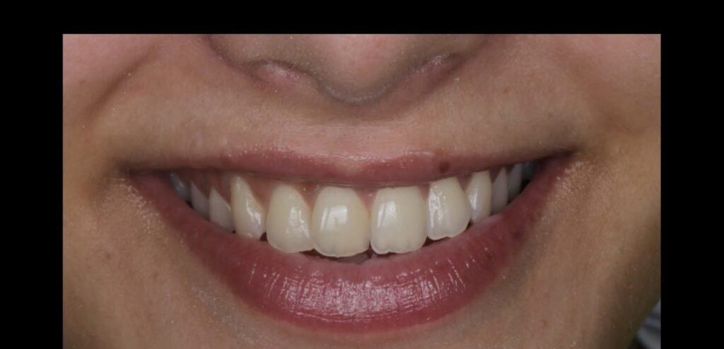 Case 11: Teeth Whitening at Plexus Dental Studio