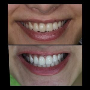 Smile Makeover