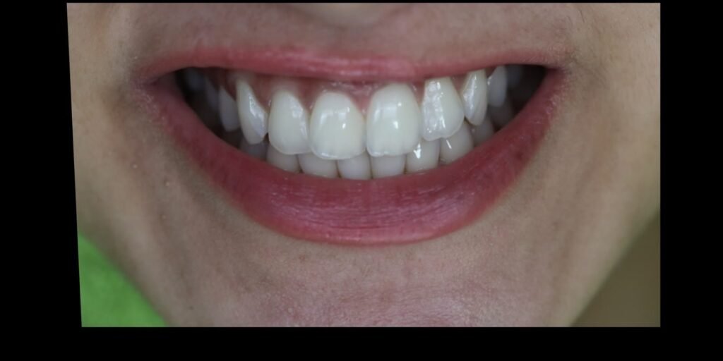 Case 11 smile transformation at Plexus Dental Studio