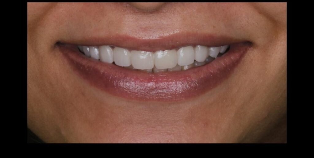 Case 12 smile transformation at Plexus Dental Studio