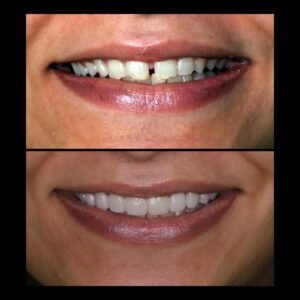 Smile Makeover
