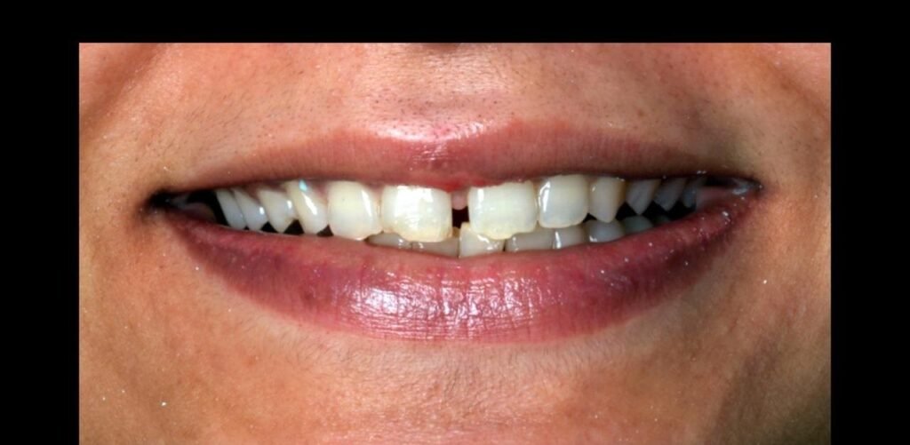 Case 12: Veneers & Smile Makeover at Plexus Dental Studio