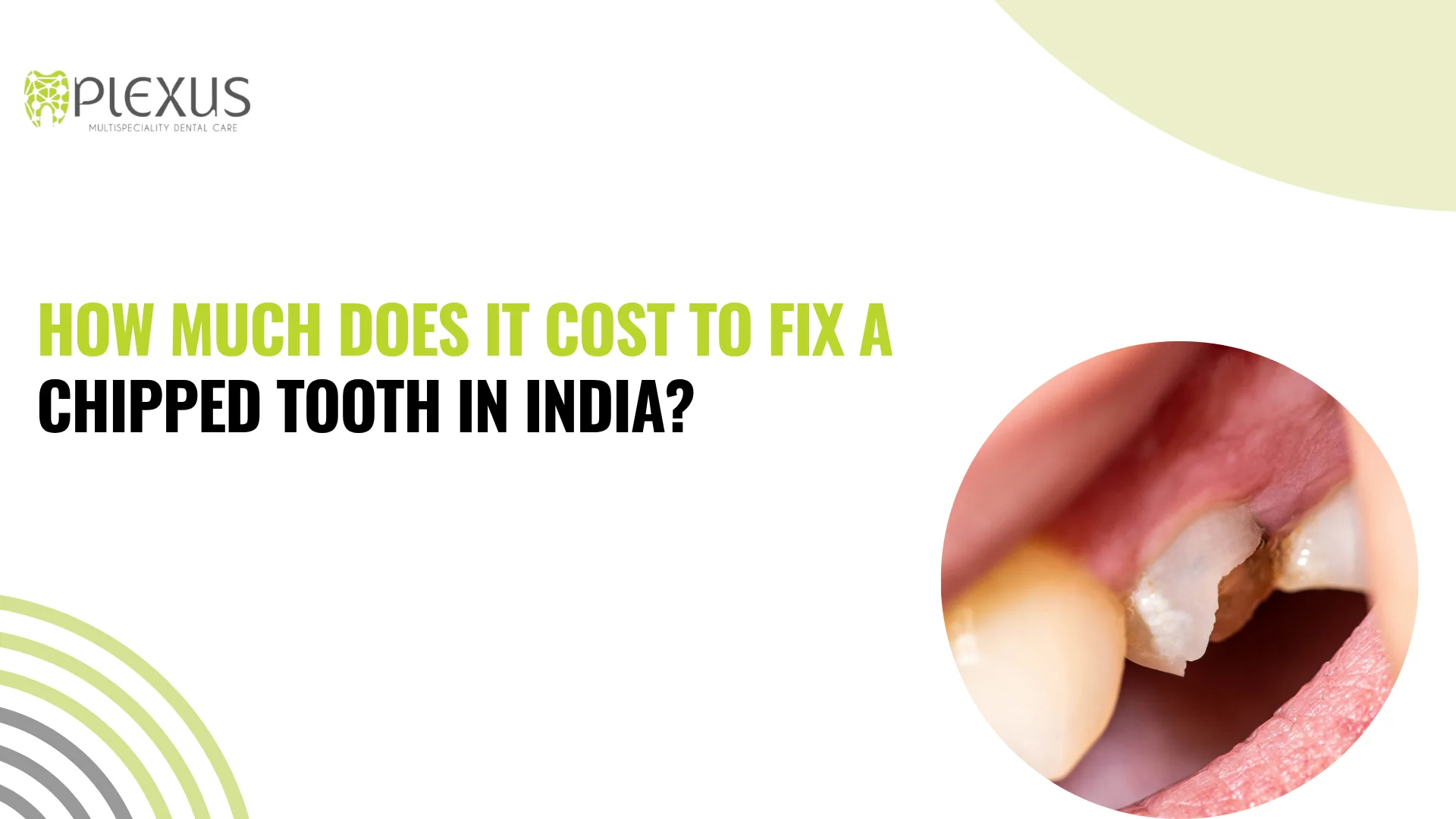 chipped tooth repair cost