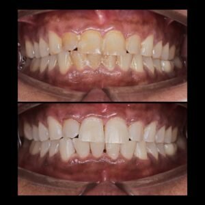 Smile Makeover