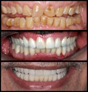 Smile Makeover