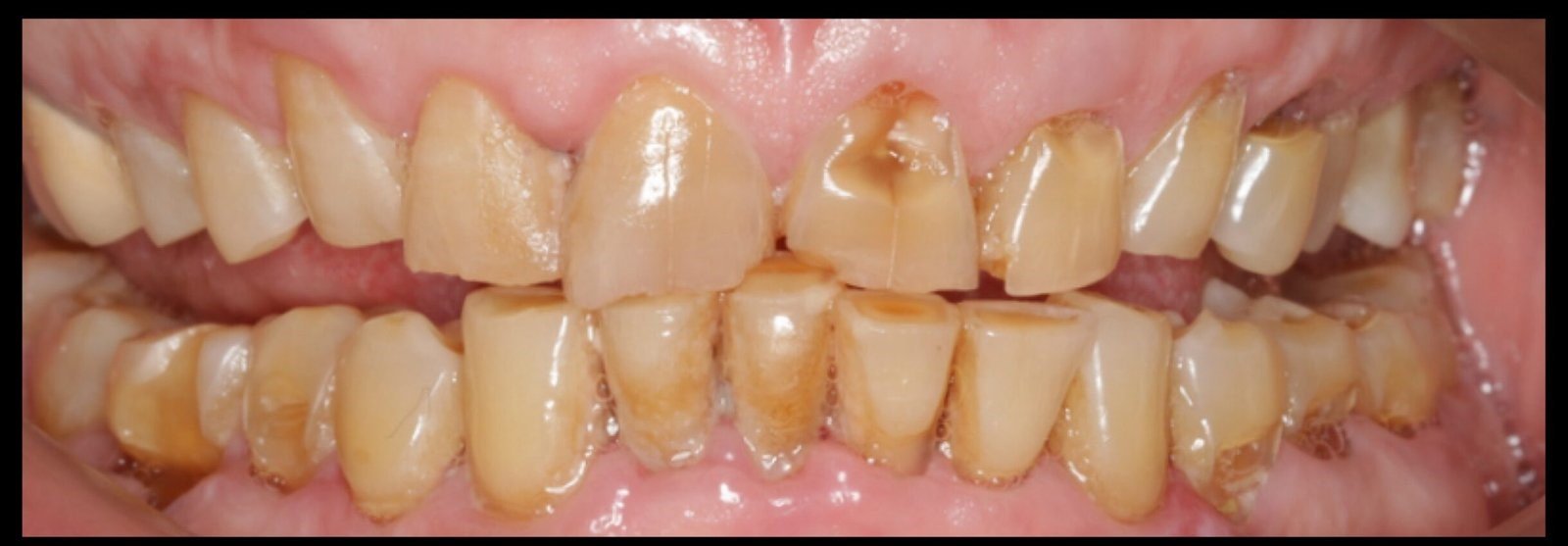Case 1: Full Mouth Rehabilitation at Plexus Dental Studio