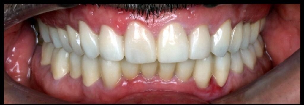 Case 1 smile transformation at Plexus Dental Studio