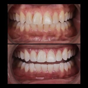 Smile Makeover