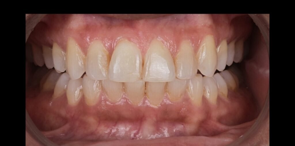Case 3: Veneers & Smile Makeover at Plexus Dental Studio