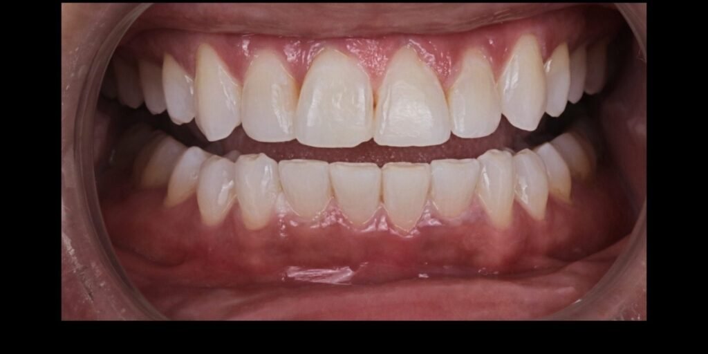 Case 3 smile transformation at Plexus Dental Studio