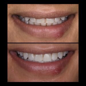 Smile Makeover