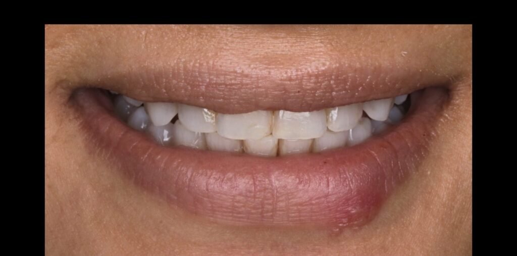 Case 4: Teeth Whitening at Plexus Dental Studio