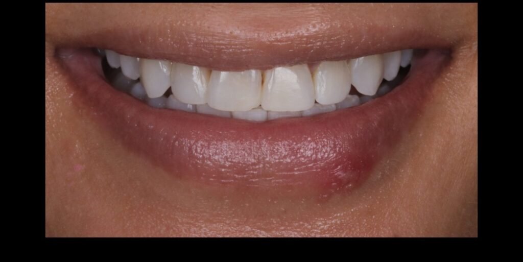 Case 4 smile transformation at Plexus Dental Studio