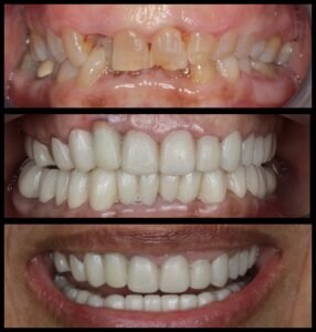 Smile Makeover