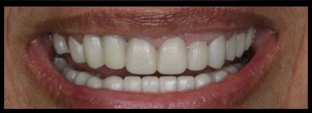 Case 5 smile transformation at Plexus Dental Studio