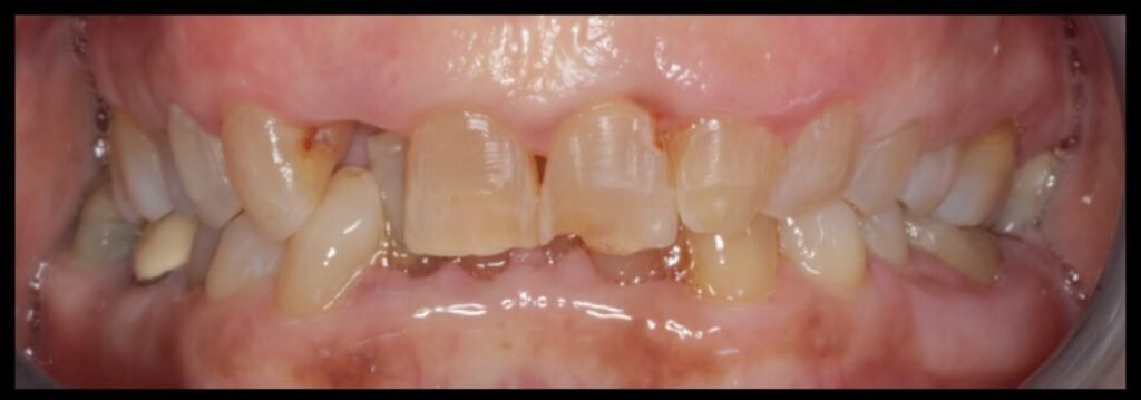 Case 5: Full Mouth Rehabilitation at Plexus Dental Studio