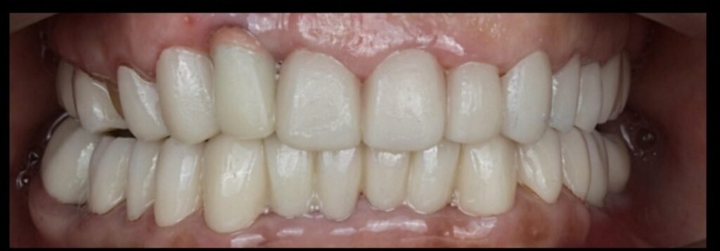 Case 5 smile transformation at Plexus Dental Studio