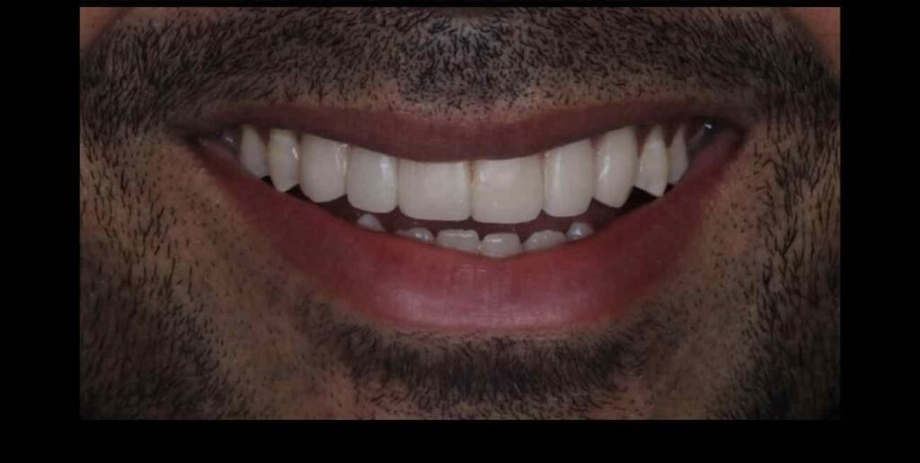 Case 10 smile transformation at Plexus Dental Studio
