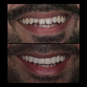 Smile Makeover