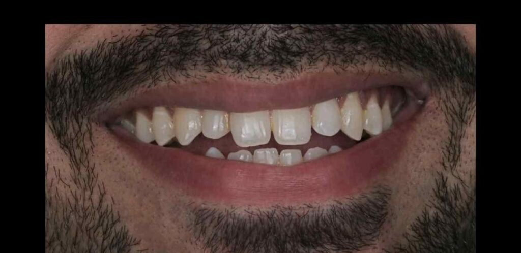 Case 10: Veneers & Smile Makeover at Plexus Dental Studio