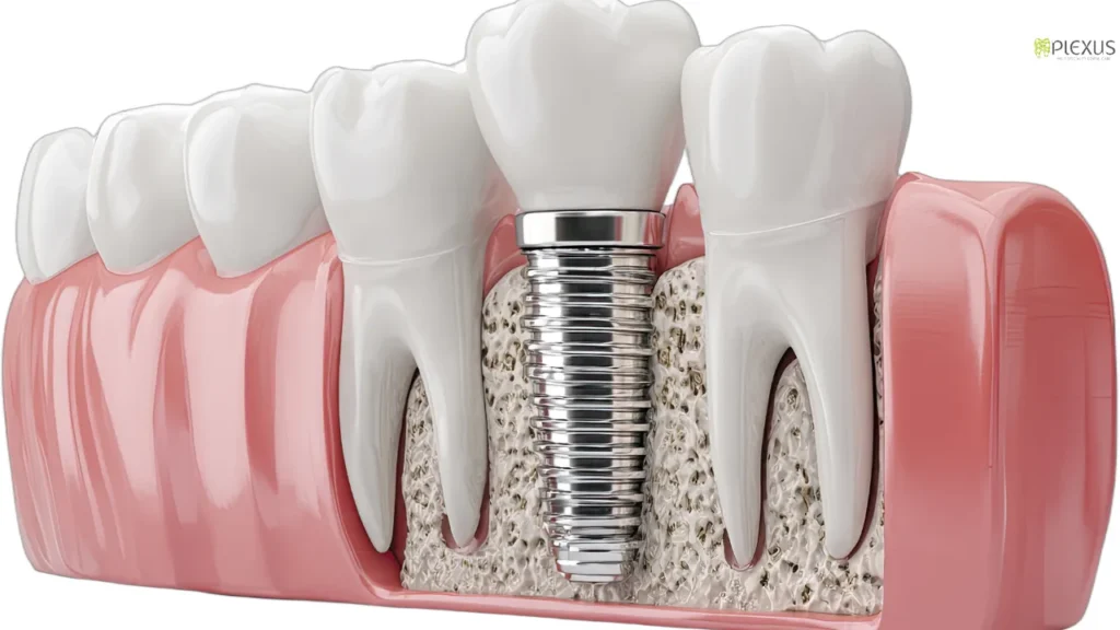 How Long Does Dental Implant Treatment Take