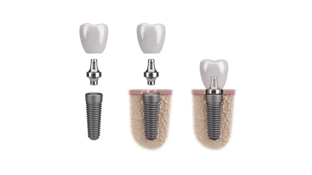 Titanium - Dental Implants