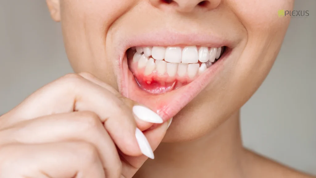 What Is Gum Recession