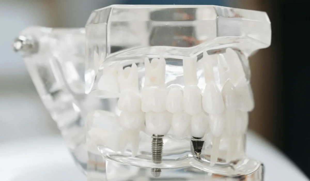 Dental Implants Plexus Dental Studio